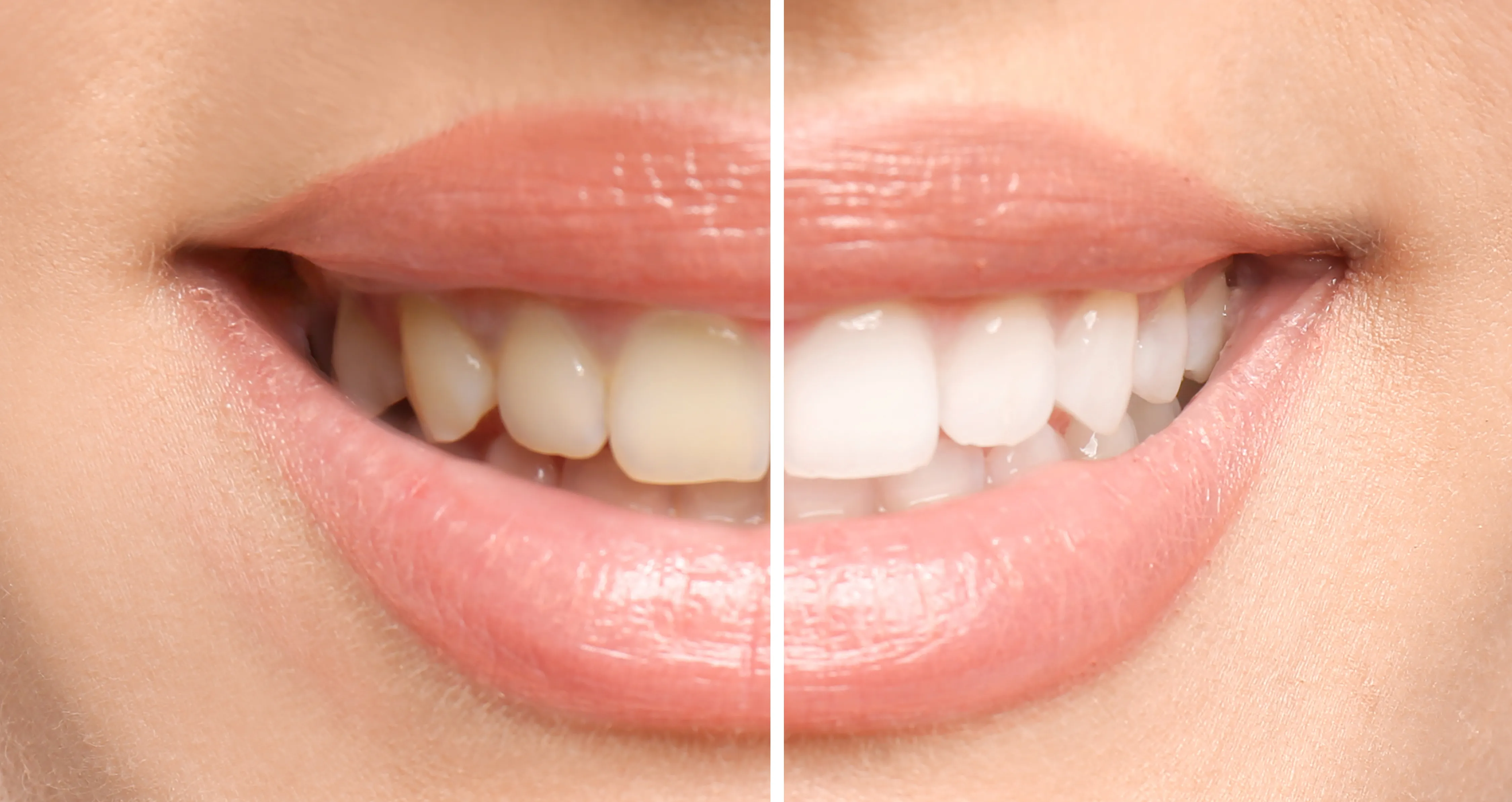 Close-up of a smiling mouth showing a half yellowed and half whitened set of teeth separated by a vertical line.