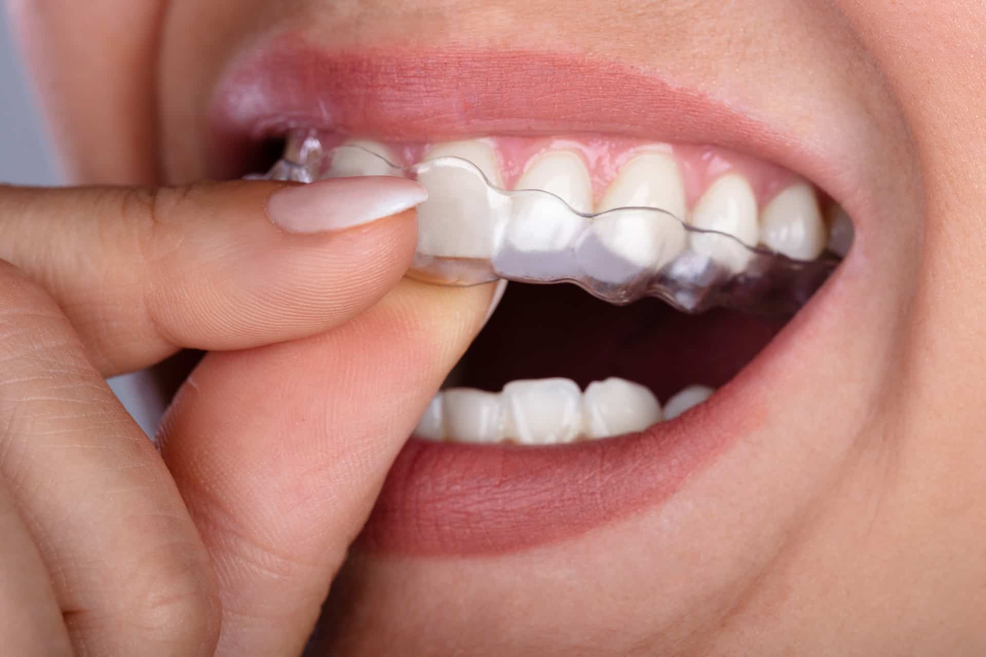 Close-up of a person with manicured nails inserting a clear dental aligner onto their upper teeth.