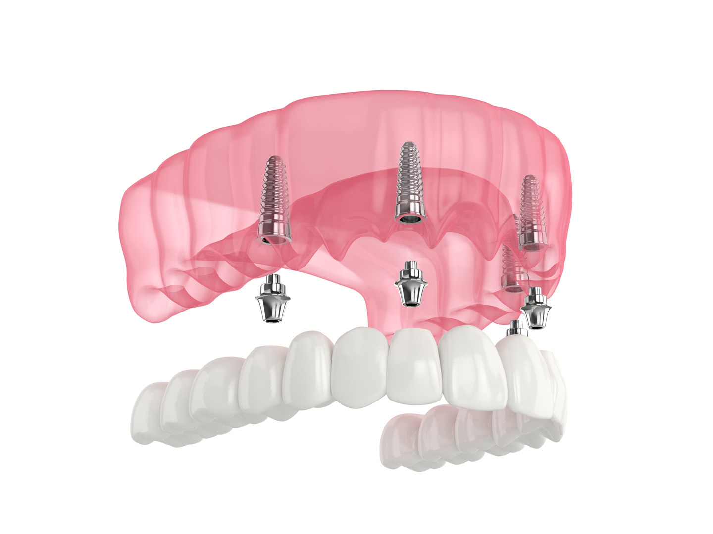 All-on-4 Dental Implants